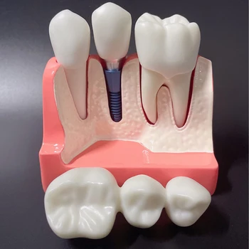 Модель зубного имплантата Съемный анализ Демонстрационная модель корончатого моста Модель зубов Анализ зубных имплантатов Модель зуба для обучения